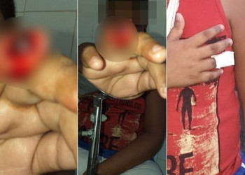 Criança tem dedo decepado durante brincadeira em escola